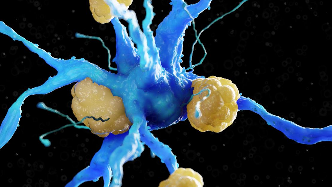 Illustration of a nerve cell with amyloid plaques.