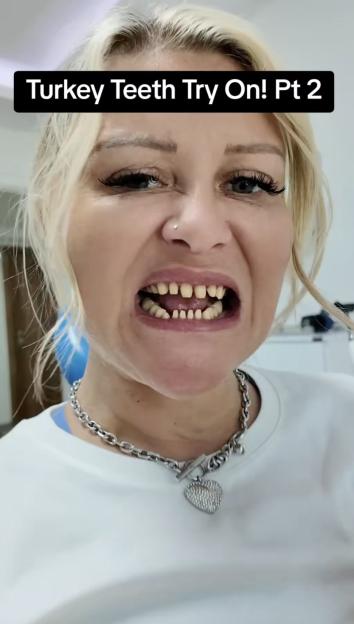 Close-up video of a woman trying on new teeth.
