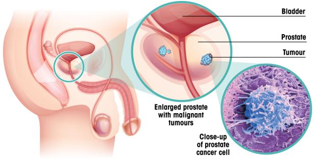 a diagram showing a close up of a prostate cancer cell