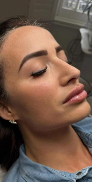 Close-up of a woman's face after a liquid facelift.