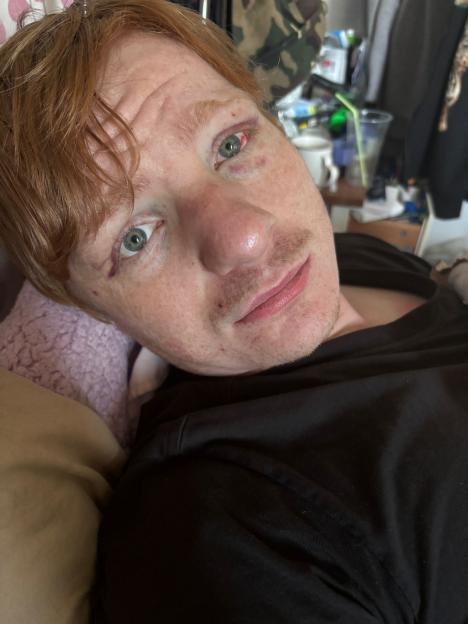 Injured Ed Sheeran lookalike Ty Jones.