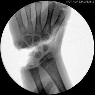 X-ray of a child's hand injured in a shark attack.
