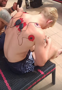 Man receiving TENS therapy.
