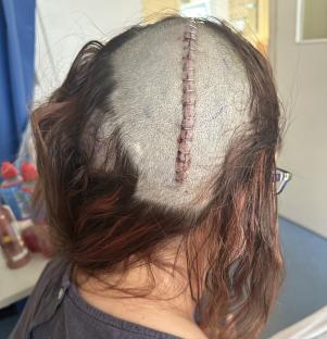 Woman's head with shaved area and surgical staples.
