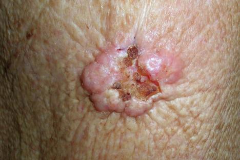 Close-up of a non-melanoma skin cancer.