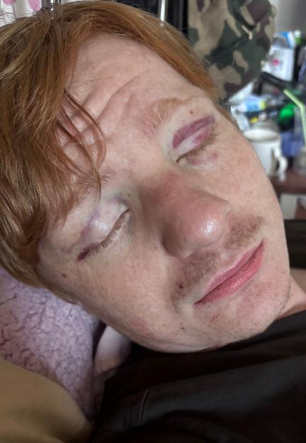 Man with black eyes and a broken nose.
