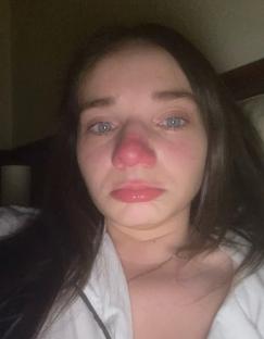 Close-up of a woman with a red nose, looking sad.