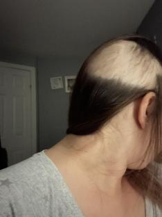 Woman's shaved head after radiotherapy.