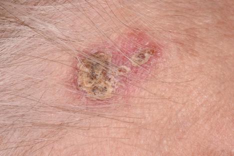 Close-up of a non-melanoma skin cancer lesion.