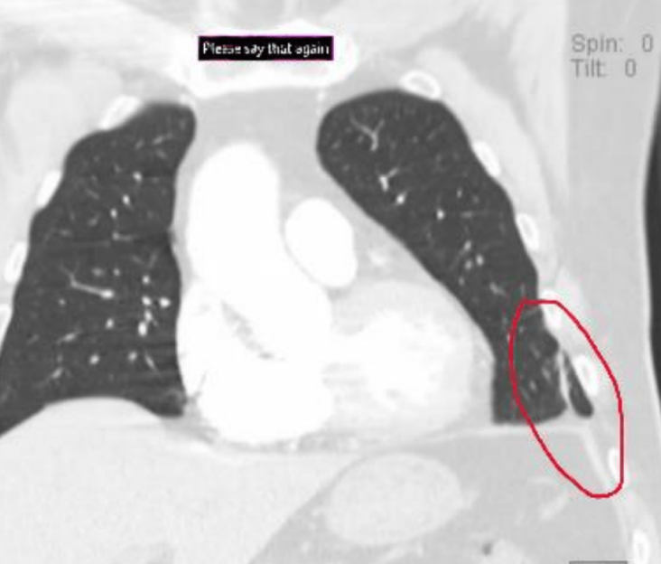 CT scan of the chest showing an abnormality in the right lung.