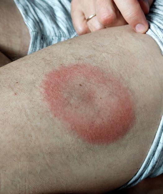 Lyme disease rash on a person's leg.