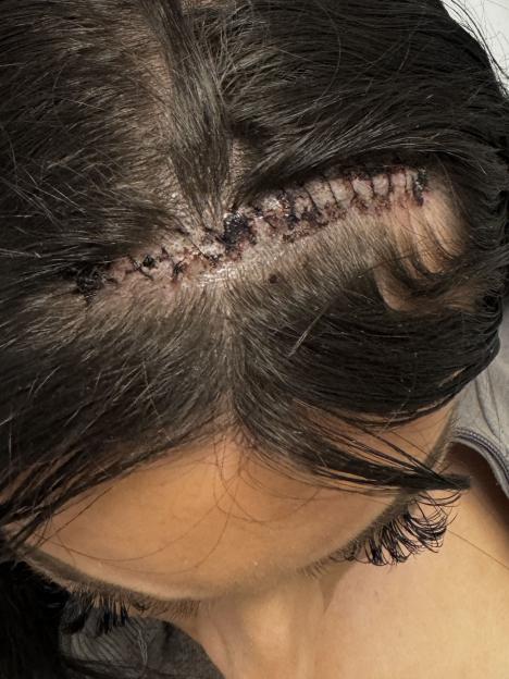 Close-up of a woman's scalp showing a surgical incision.