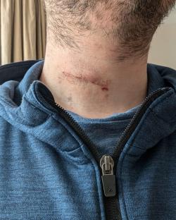 Close-up of a scar on a person's neck.