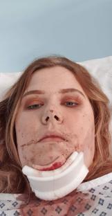 Woman in hospital with a broken jaw and neck brace.