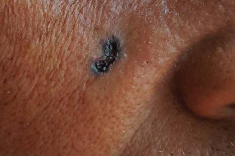 Close-up of a non-melanoma skin cancer lesion.