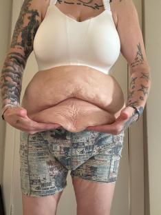 Woman's abdomen with excess skin after weight loss.