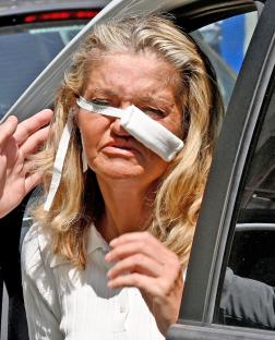 Danniella Westbrook leaving the hospital after nose surgery.