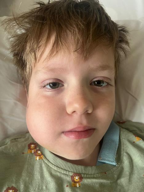Close-up of a young boy with swollen cheek.