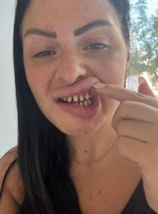 Close-up of a woman showing her teeth before getting crowns.
