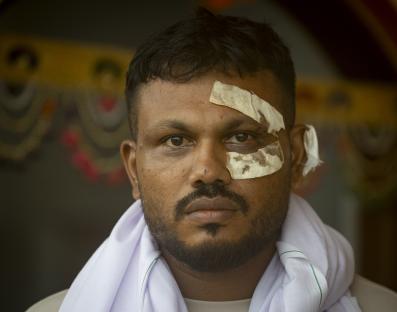 Portrait of Vishwas Ramesh, sole survivor of an Air India plane crash, with bandages on his face.