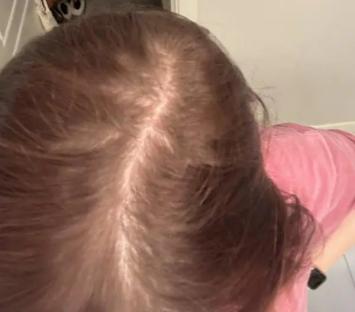 Person's head showing thin hair.