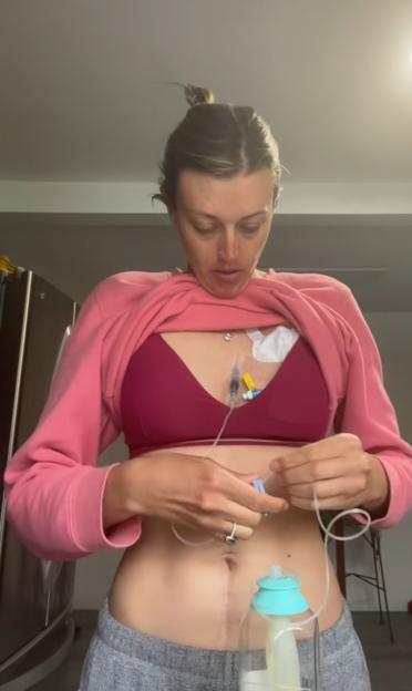 Woman connecting chemotherapy port to at-home treatment.