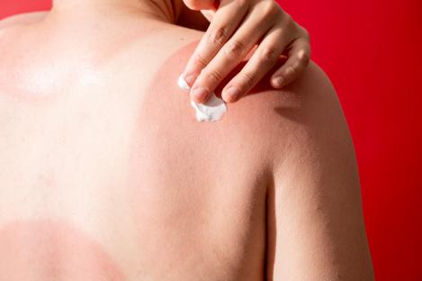 Person applying lotion to sunburned back.