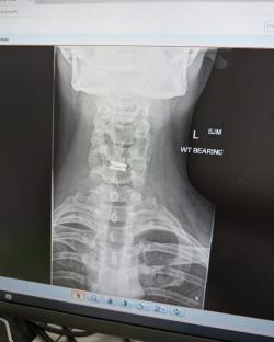 X-ray of male neck showing WT bearing.