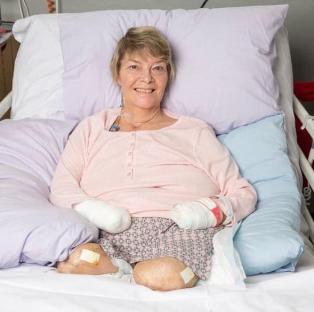 Woman with quadruple amputations in hospital bed.
