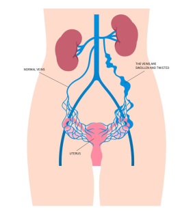 Illustration of swollen and twisted veins near the uterus and kidneys.