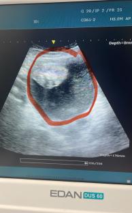 Ultrasound image of a large ovarian cyst.