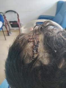 Head wound with staples.