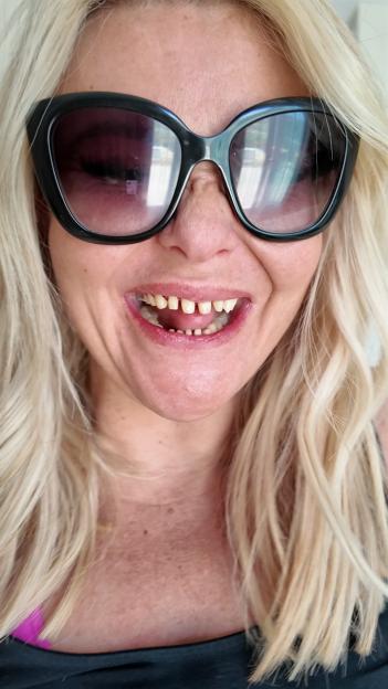 Close-up of a woman's damaged teeth.
