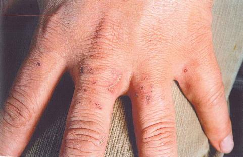 Close-up of injuries to a hand.