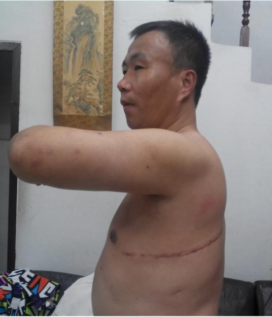 Man's torso showing surgical scars.