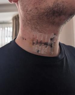 Close-up of a man's neck with a bandage over a surgical incision.