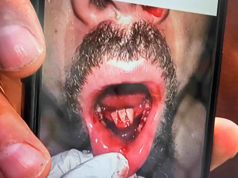 Close-up photo of a bloody mouth injury.