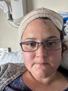 Woman in hospital bed after craniotomy.