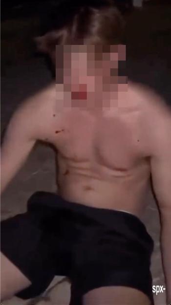 A young man with blood on his torso after being assaulted.