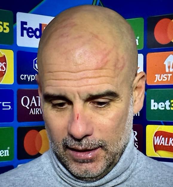 Pep Guardiola with scratches on his head and a cut on his nose.