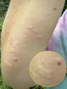 Close-up of welts on a person's arm after stinging nettle treatment.