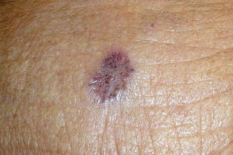 Close-up of a non-melanoma skin cancer lesion.