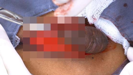 Close-up of a chest keloid removal surgery.