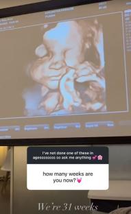 31-week pregnancy ultrasound image.