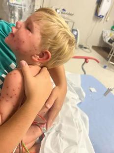 Toddler covered in wasp stings in hospital bed.