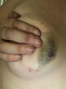 Close-up of a bruise on a person's chest.