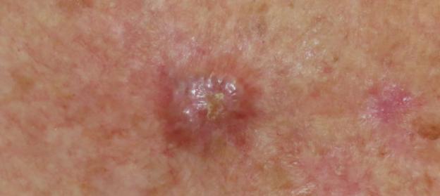 Close-up of a non-melanoma skin cancer.