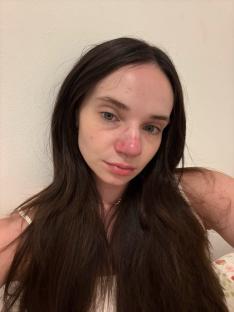 Woman with a persistently red nose.