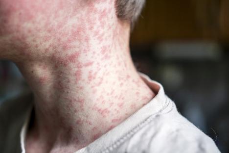 Close-up of measles rash on a person's neck and shoulder.