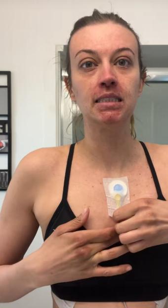 Woman displaying her chest port.